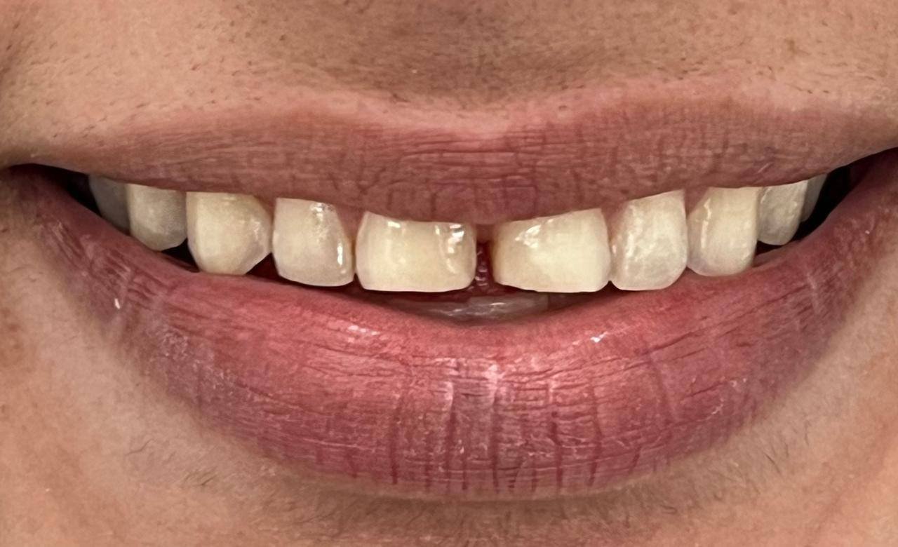 Detalle de sonrisa estética