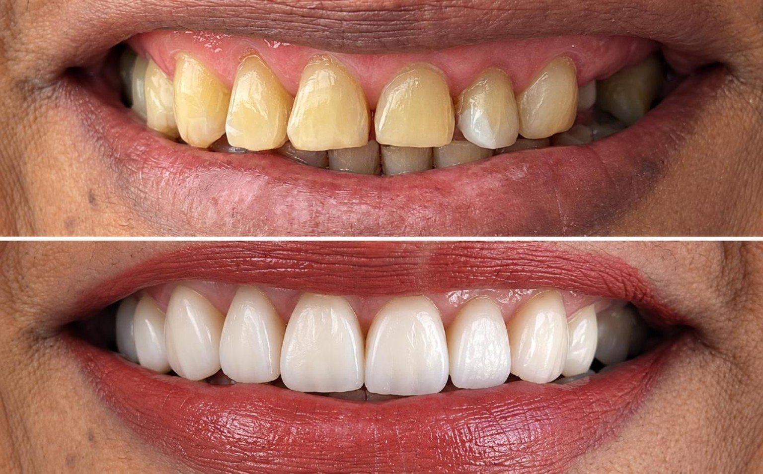 Comparación antes y después de una sonrisa