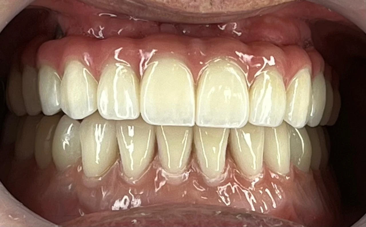 Resultado estético dental